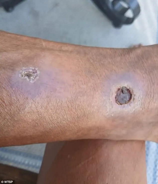 Privileged Access: Apartment Complex Fails to Address Spider Infestation, Leading to Amputation and Lawsuit