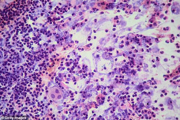 San Francisco's Archbishop Riordan High School Faces First-Ever TB Outbreak, Leading to Closure and Public Health Alert