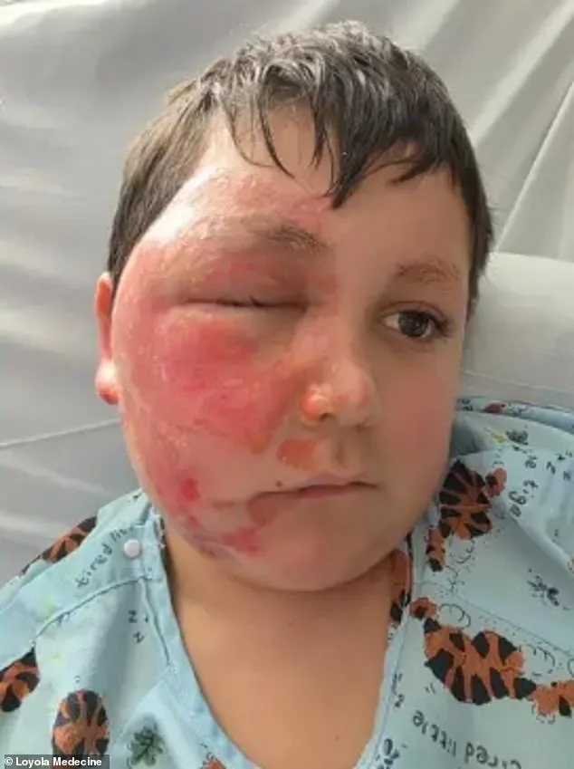 14-Year-Old Suffers Life-Altering Burns After Attempting Viral TikTok Fire-Breathing Challenge, Officials Warn of Dangers