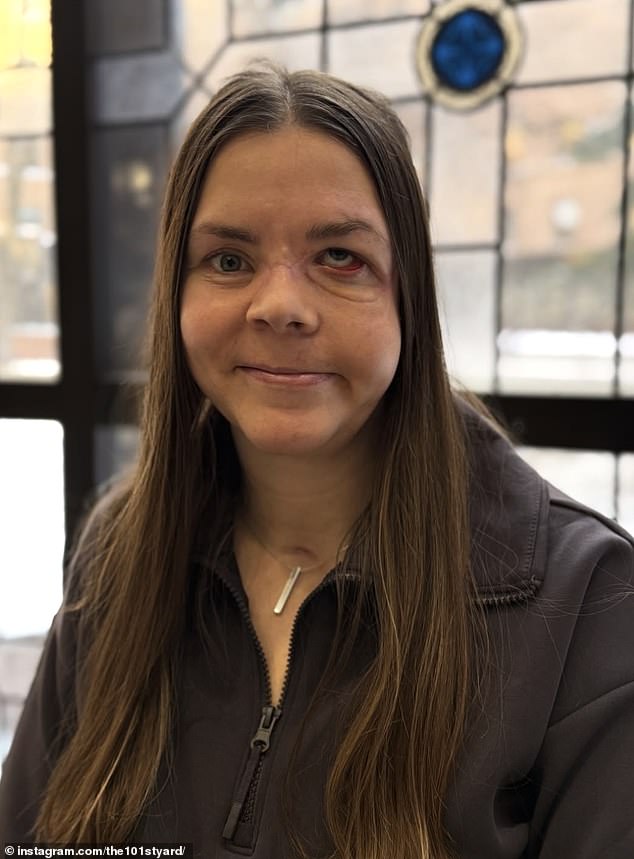 Kenai mother reveals full extent of bear attack injuries eight months later