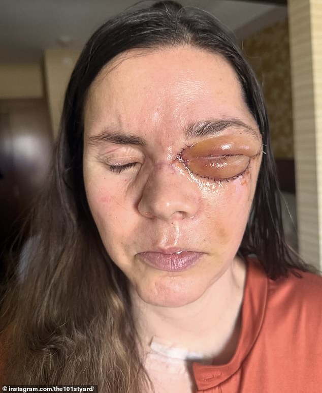 Kenai mother reveals full extent of bear attack injuries eight months later