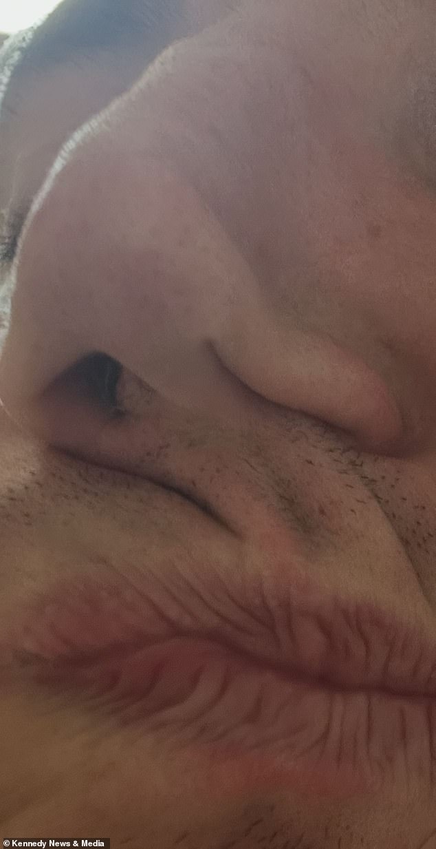 Man loses nose after spending £35,000 on cocaine