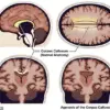 Exploring the Realities of Agenesis of the Corpus Callosum: Beyond Fictional Split Consciousness