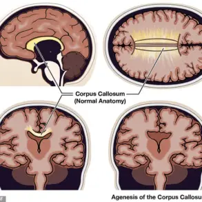 Exploring the Realities of Agenesis of the Corpus Callosum: Beyond Fictional Split Consciousness