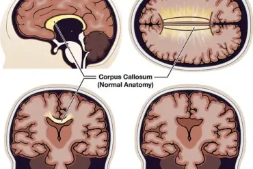 Exploring the Realities of Agenesis of the Corpus Callosum: Beyond Fictional Split Consciousness