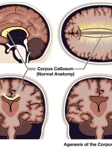 Exploring the Realities of Agenesis of the Corpus Callosum: Beyond Fictional Split Consciousness