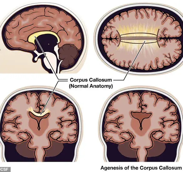 Exploring the Realities of Agenesis of the Corpus Callosum: Beyond Fictional Split Consciousness