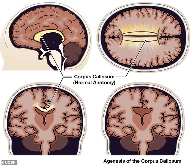 Exploring the Realities of Agenesis of the Corpus Callosum: Beyond Fictional Split Consciousness