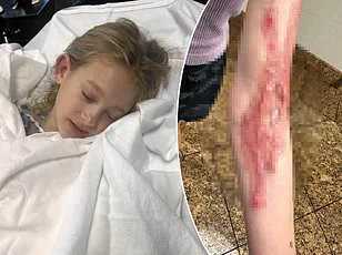 TikTok Mom Heartbreakingly Announces Death of Daughter After Long Battle with Rare Skin Condition