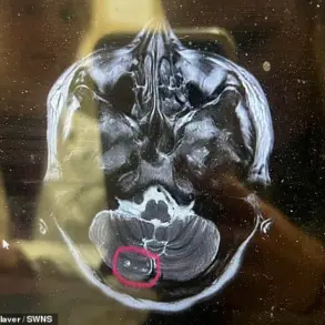 Breaking: Routine Botox Procedure Spirals into £22,000 Medical Crisis, Leaving Mother of Three Bedridden