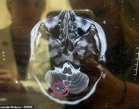 Breaking: Routine Botox Procedure Spirals into £22,000 Medical Crisis, Leaving Mother of Three Bedridden