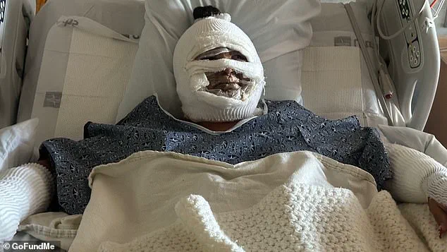 Urgent Alert: Hidden Dangers of Tabletop Fire Pits Expose Severe Risks After Teen Suffers Burns in Laguna Niguel